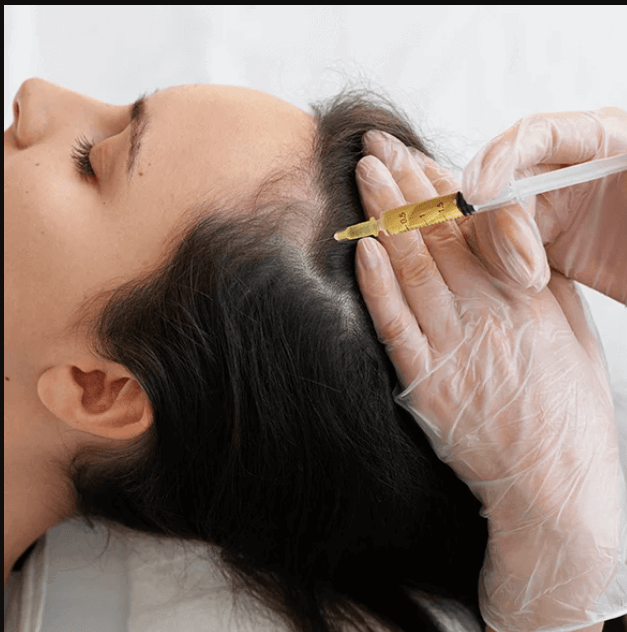 PRF vs Minoxidil: Which Provides Better Hair Growth?